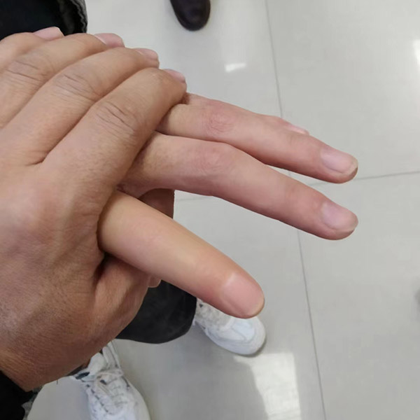 上肢假肢