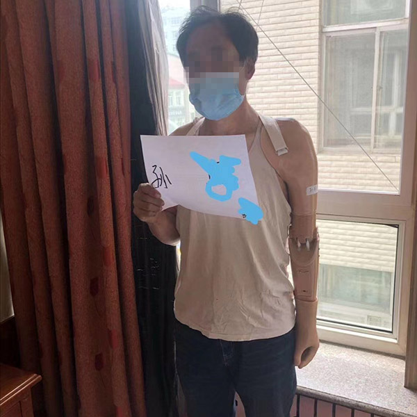 上肢假肢