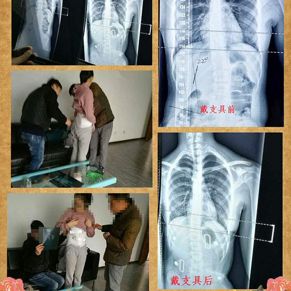 脊柱侧弯矫形支具